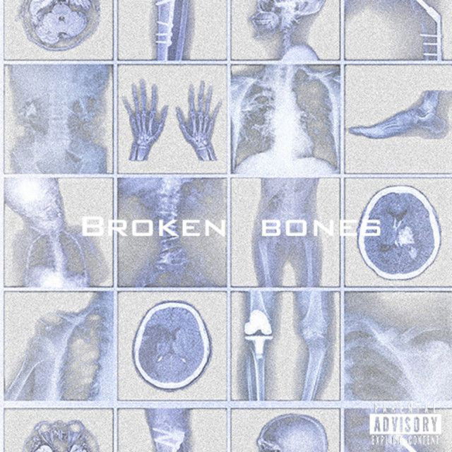 Broken Bones